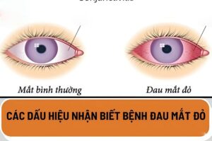 dấu hiệu đau mắt đỏ