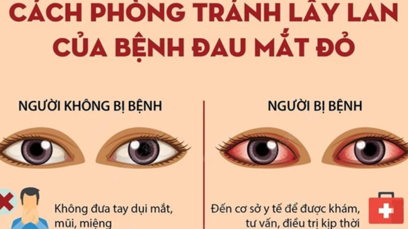 lây đau mắt đỏ