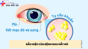 dấu hiệu của bệnh đau mắt đỏ