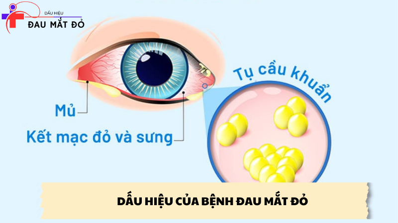 dấu hiệu của bệnh đau mắt đỏ