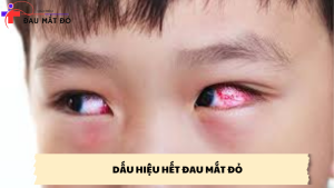 dấu hiệu hết đau mắt đỏ