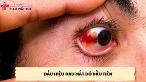 dấu hiệu đau mắt đỏ đầu tiên